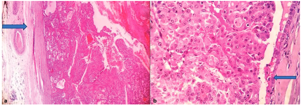 (a) A well-encapsulated tumor showing tumor cells arranged in papillary, cribriform, and tubular pattern showing the capsule (blue arrow; hematoxylin and eosin [H&E] stain, 10x). (a) No myoepithelial cells at the tumor margin (blue arrow; H&E stain, 40x).